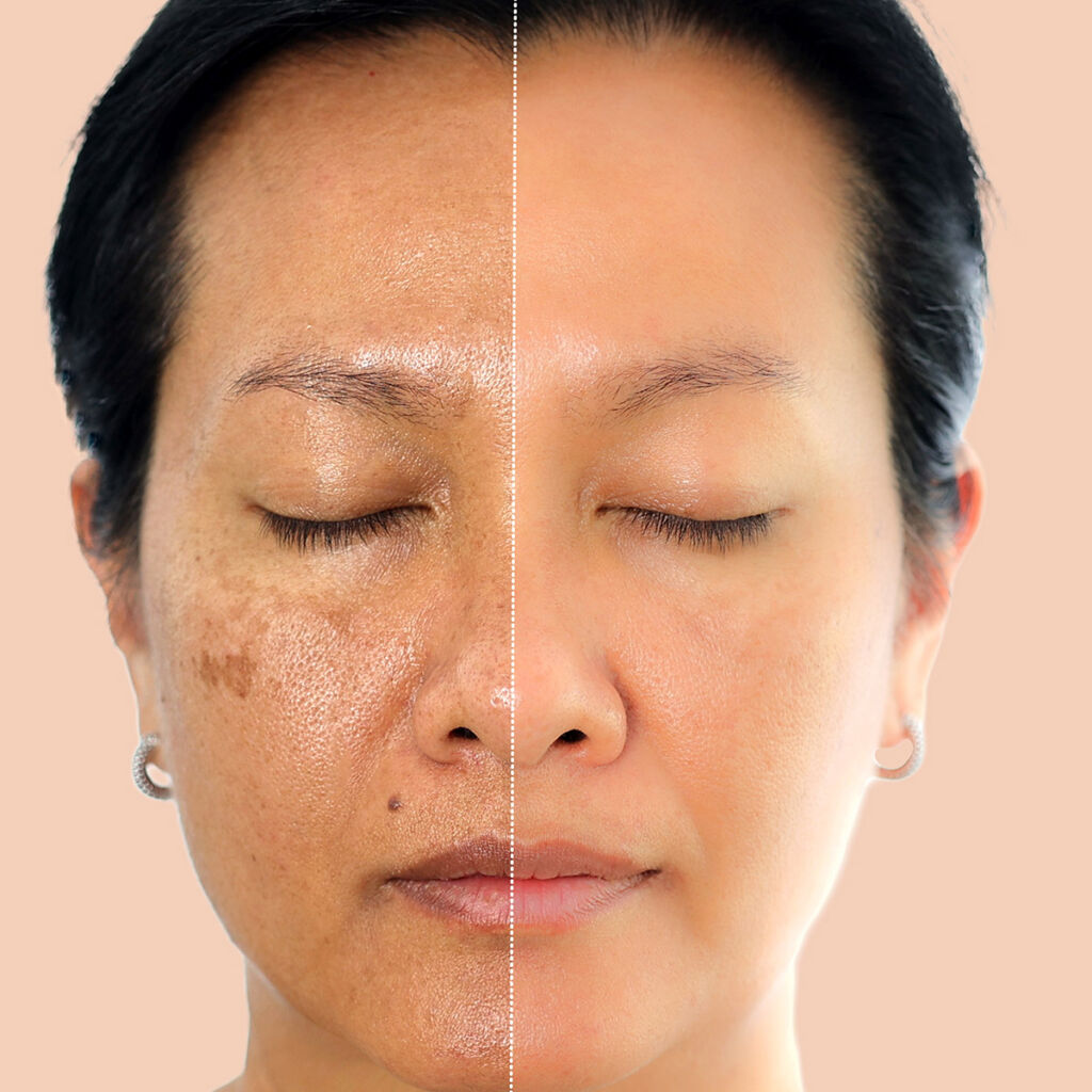 pigmentation-treatment-envy-aesthetics
