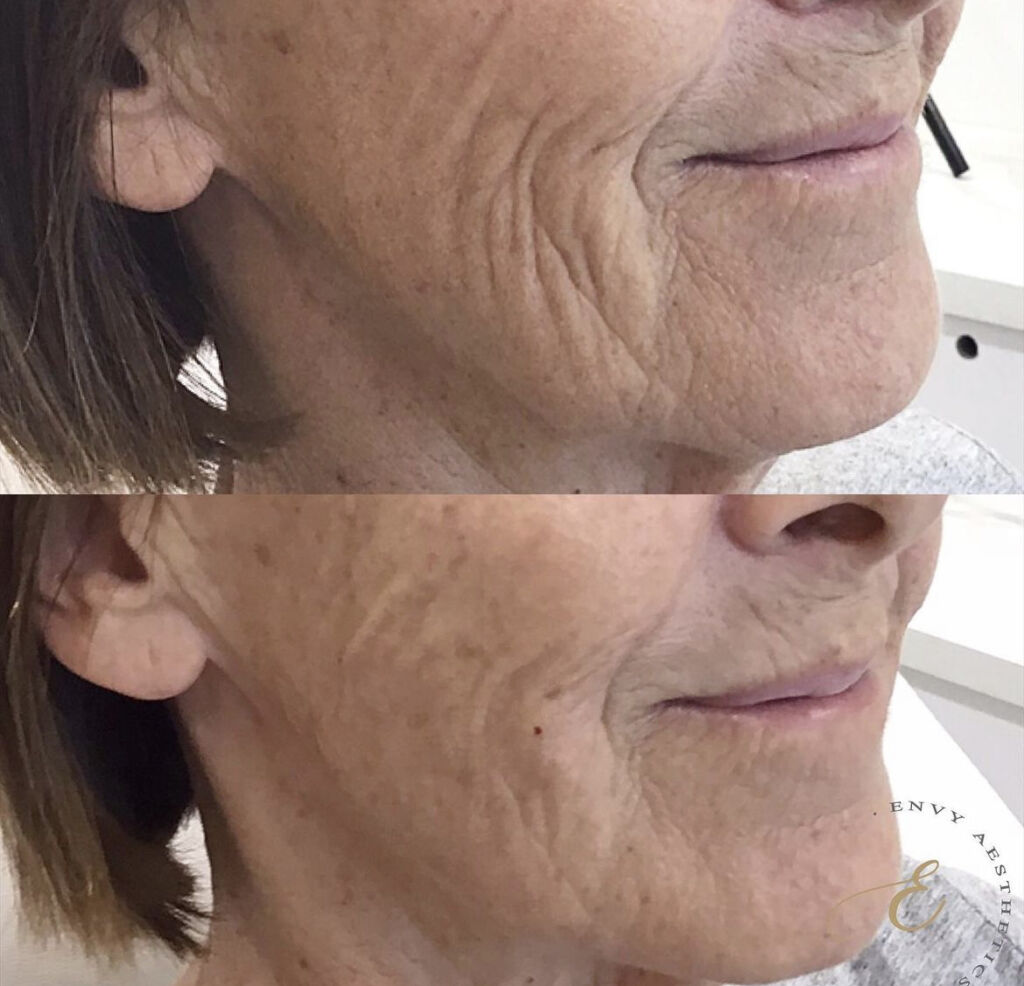 envy-aesthetics-skin-boosters
