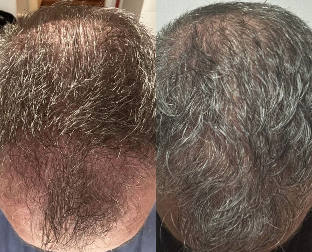 PRP-Treatment-Envy-Aesthetics