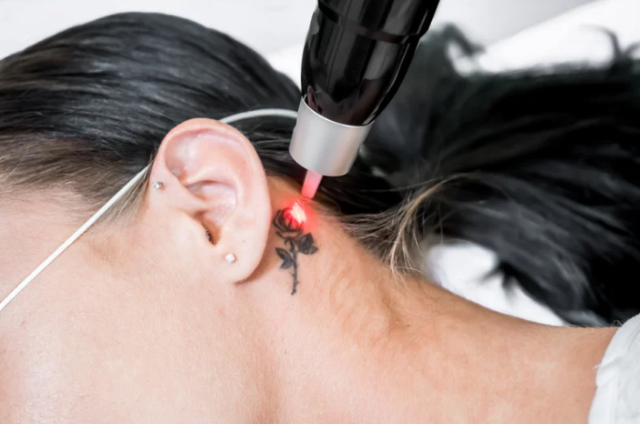 tattoo-removal-envy-aesthetics